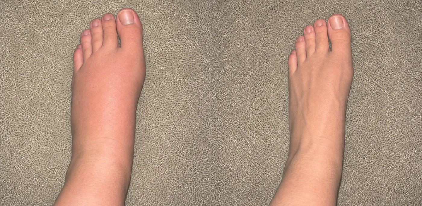 Swollen foot next to a healthy foot