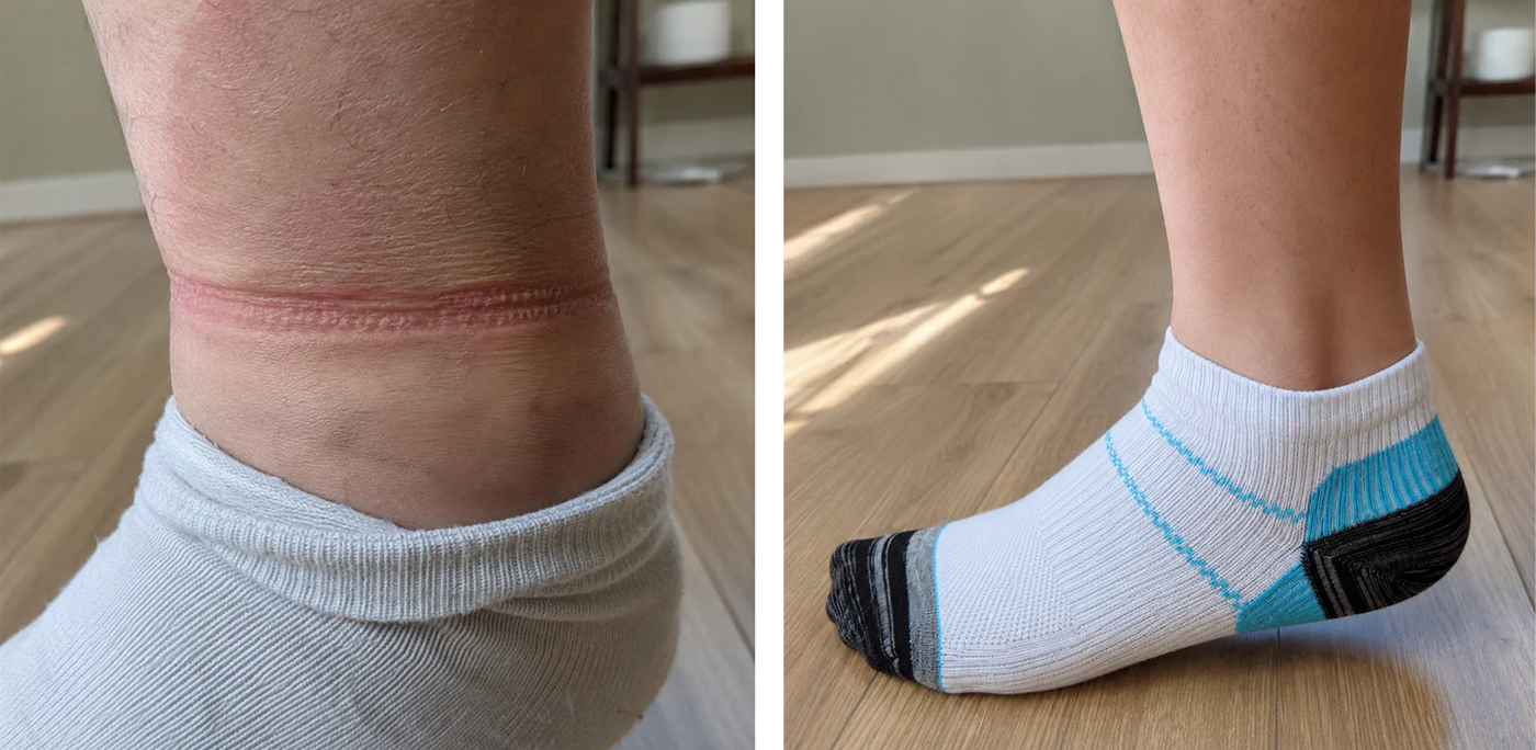 Before and after: ordinary sock marks versus the Archly sock