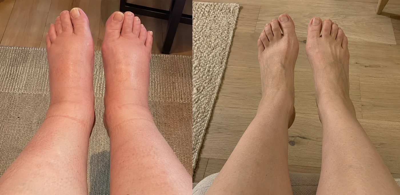 Swollen legs and feet before, slim and healthy after